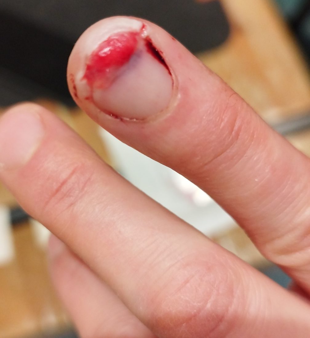 Fingerverletzung vor der Behandlung