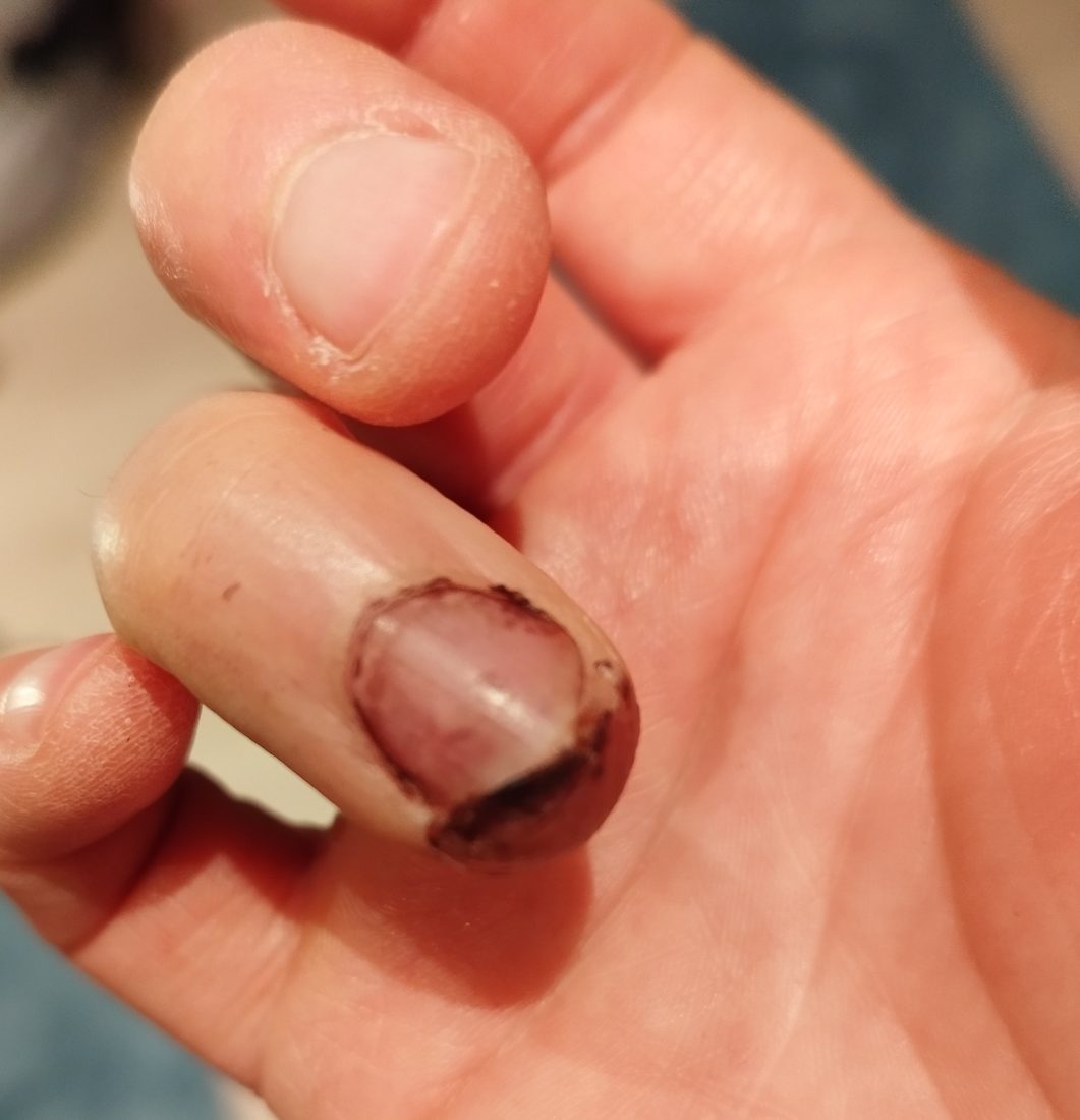 Fingerverletzung nach der ersten Behandlung